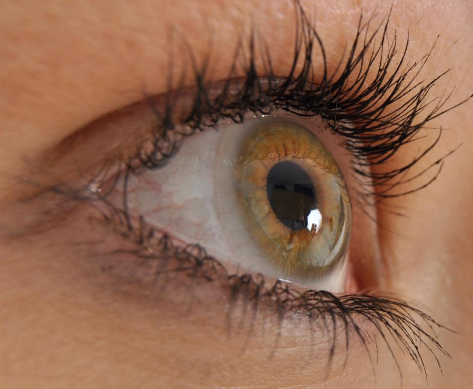Iridotomy creates a hole in the iris to allow the draining of ocular fluid.