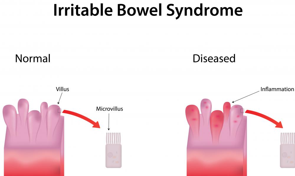 Passiflora incarnata is an ideal homeopathic treatment for irritable bowel syndrome.