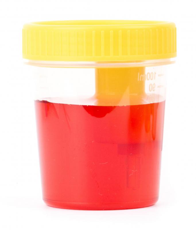 Urine cytology can be requested if a patient has bloody urine.