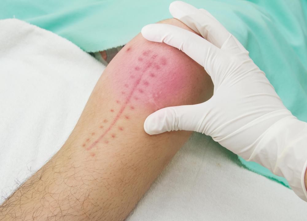 Surgeons often use sutures that have to be removed by a medical practitioner.