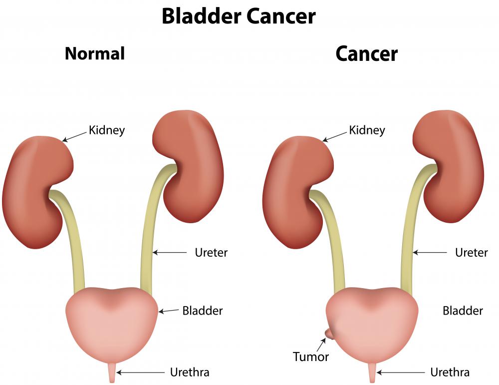 A history of bladder cancer can increase the likelihood of developing ureter cancer.