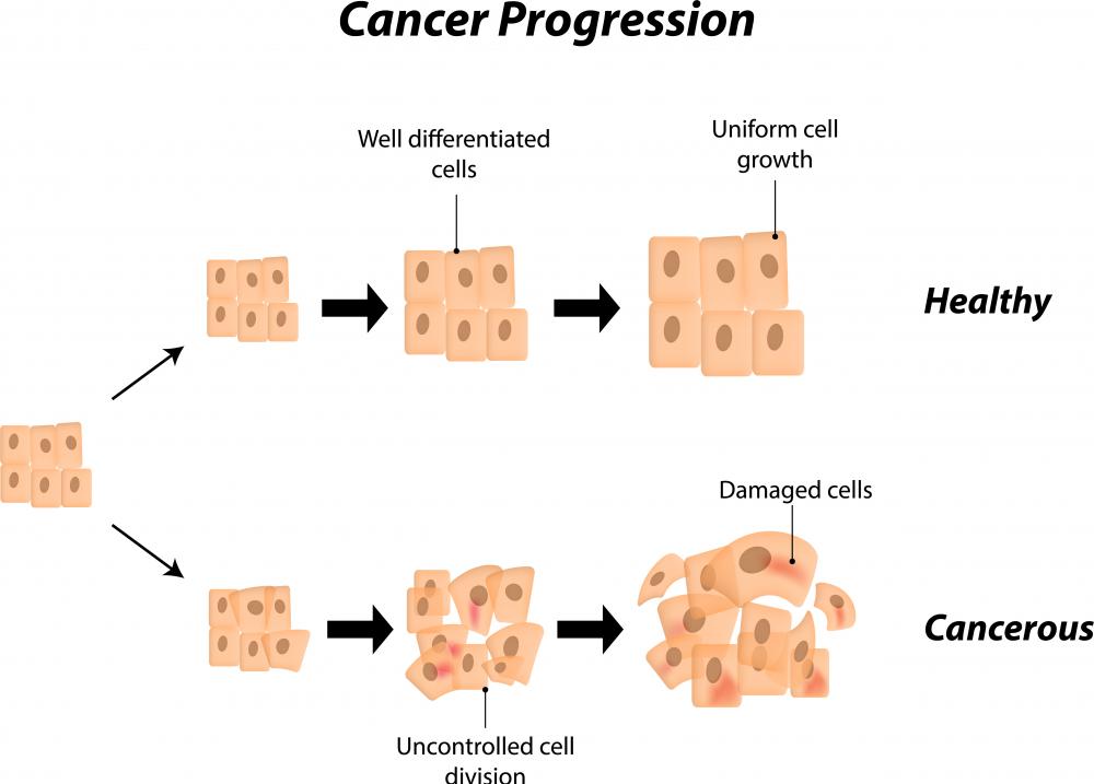 Cancer of the ampulla of vater often metastasizes into the lymph nodes, and the five-year survival rate is only about 40 percent.