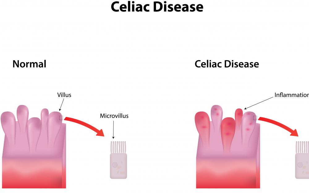 Most insulin supplements are gluten free, making them safe for people with celiac disease.