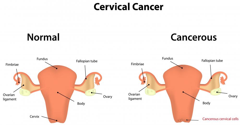 Cervical cancer that's caused by atypical glandular cells tends to be more aggressive.