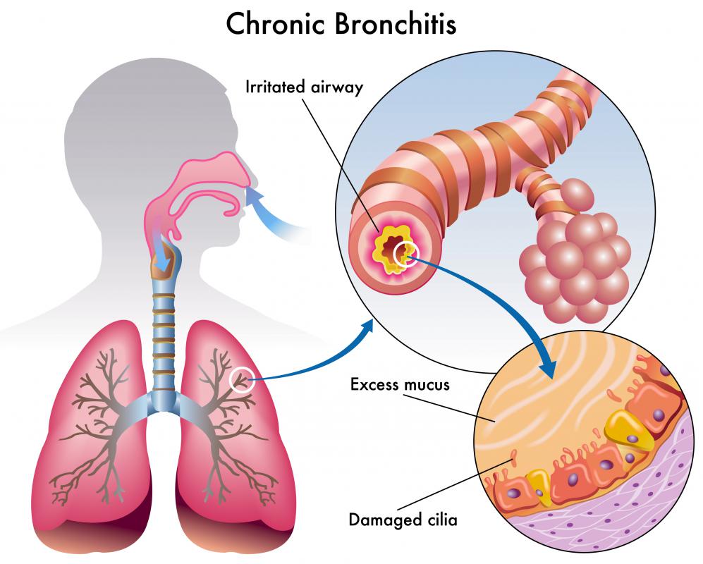Chronic bronchitis can lead to hemosiderosis.