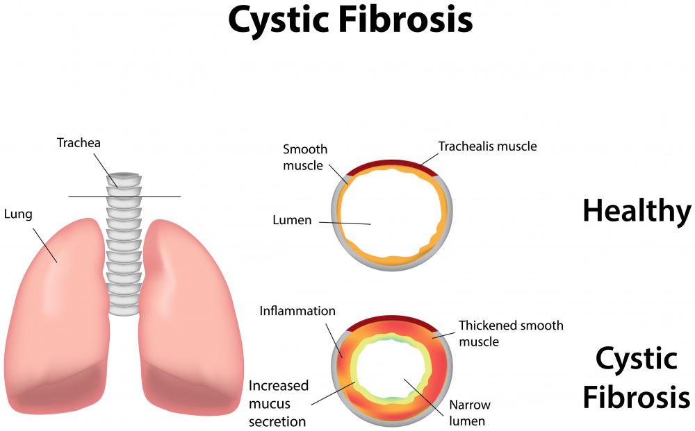 A swollen pancreas can be caused by cystic fibrosis.