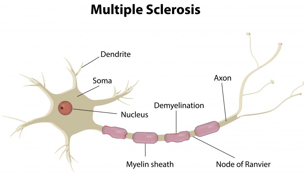 Degeneration of the myelin sheath is associated with multiple sclerosis.