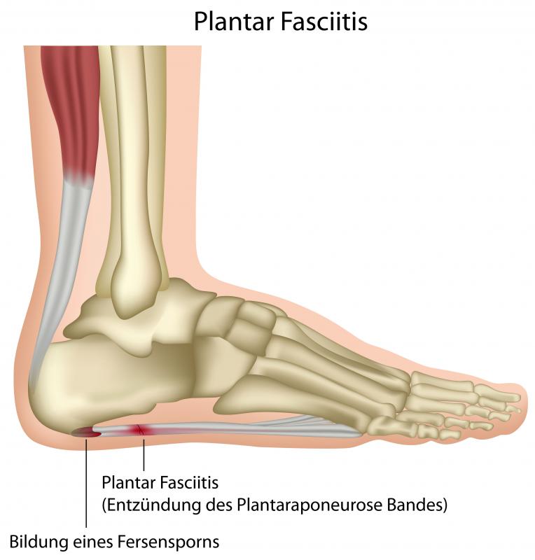 A sore heel may be caused by plantar fasciitis.