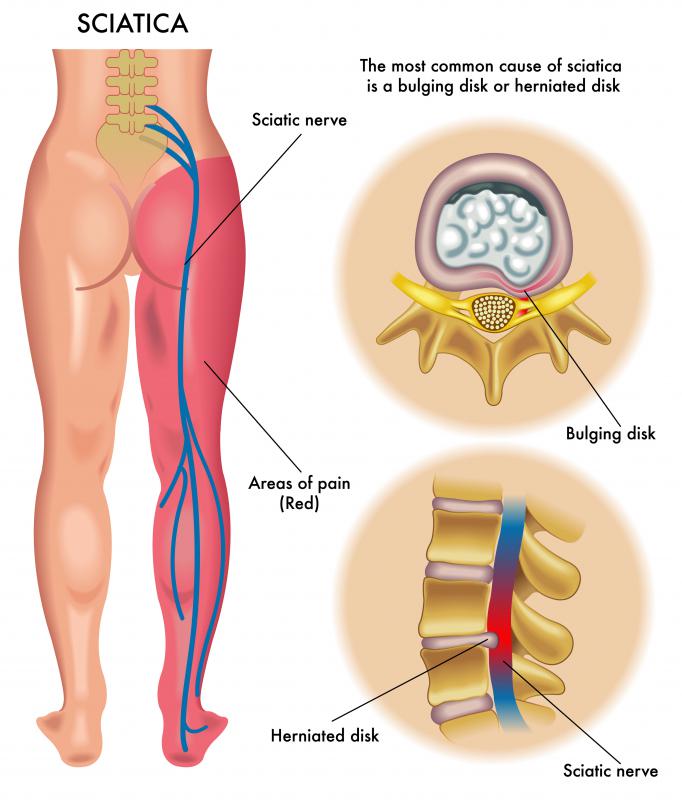 If the sciatic nerve becomes irritated, it can cause pain and numbness down the leg.
