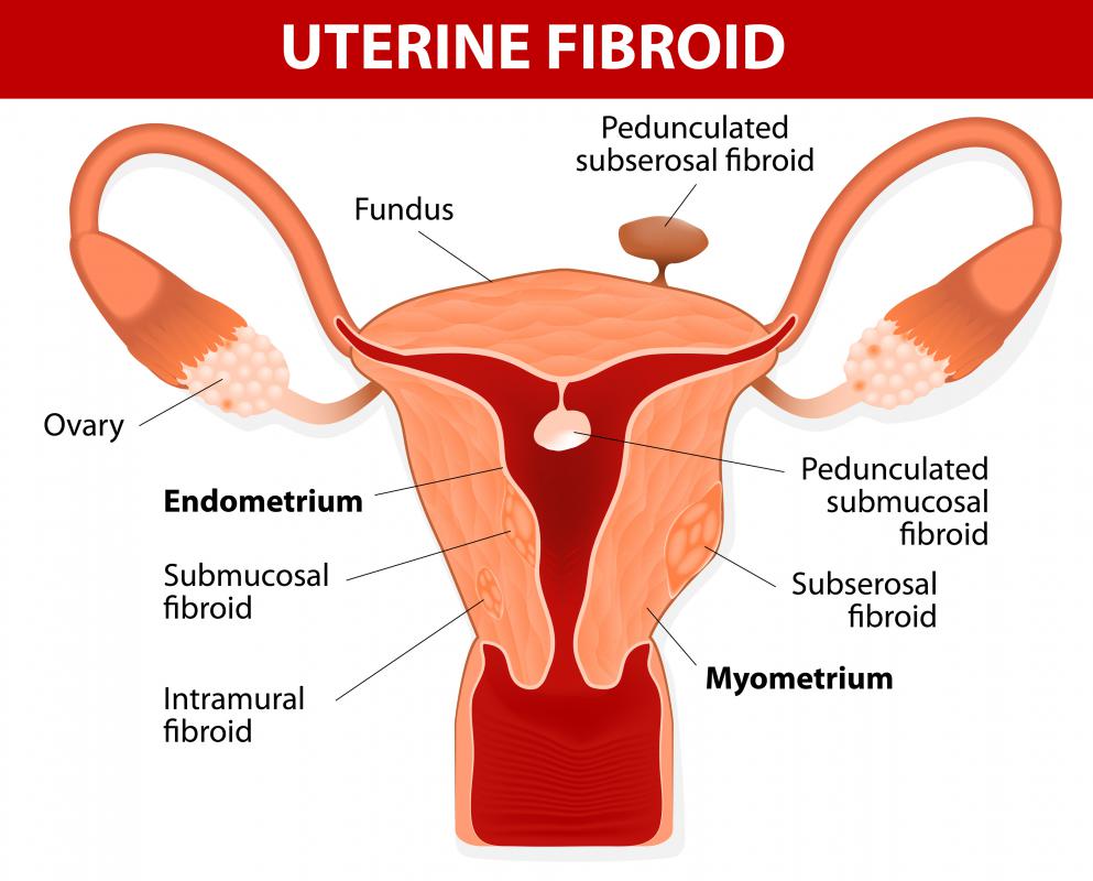 A subtotal hysterectomy may be performed if a woman is suffering from uterine fibroids.
