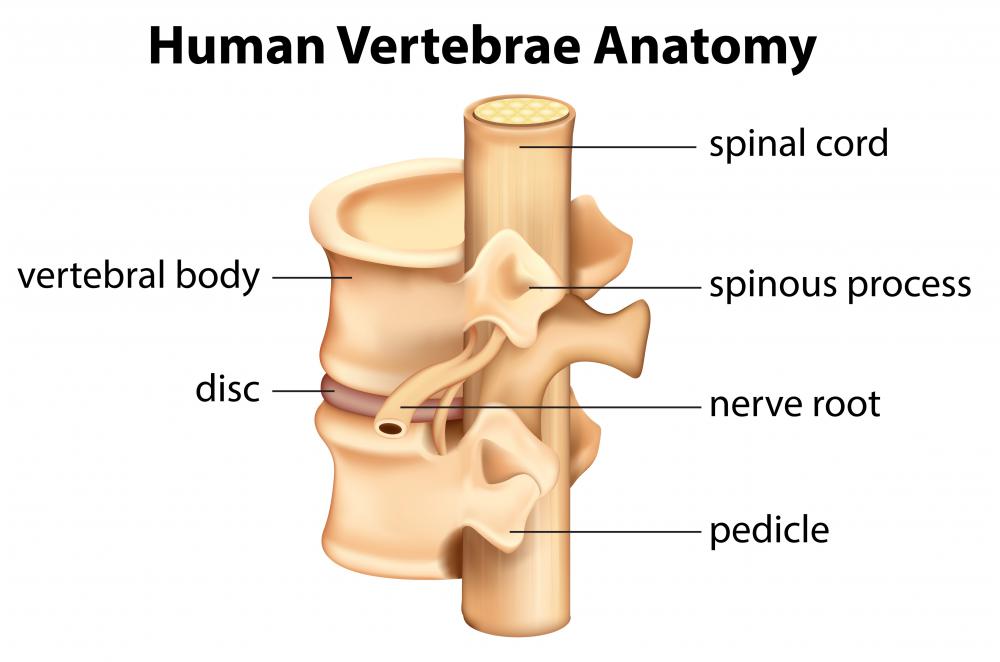 In a hemilaminectomy, a surgeon removes the laminae, which is part of the spine, from one side of the vertebrae.