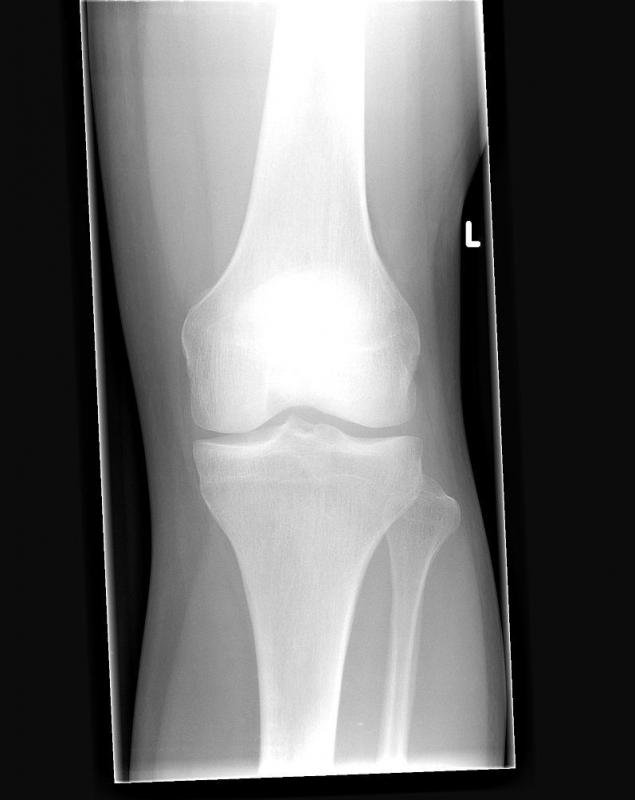 Front x-ray of a healthy left knee. X-rays can identify the presence or absence of knee osteophytes.
