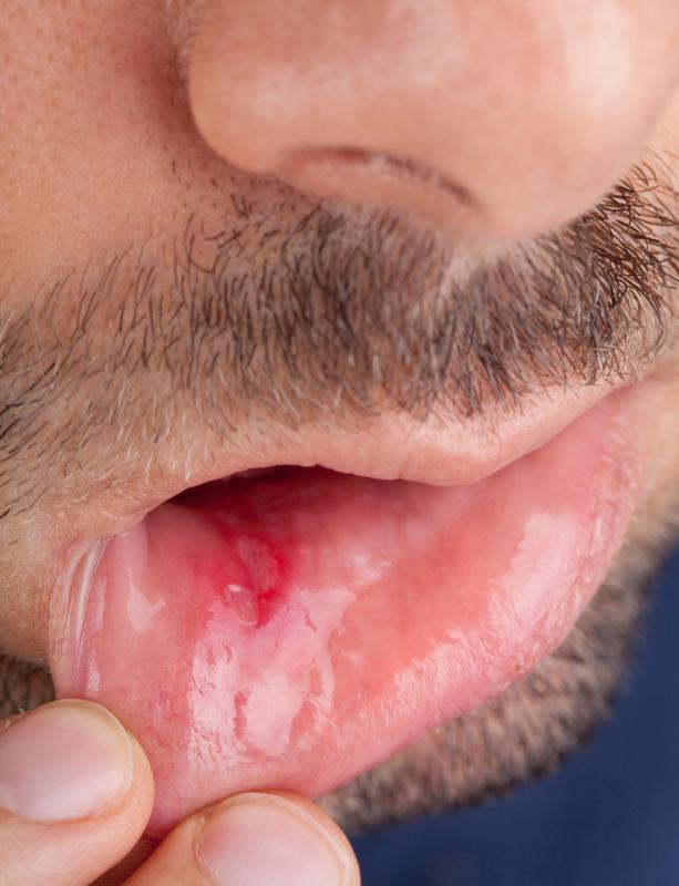 Canker sores are sometimes called gum blisters.