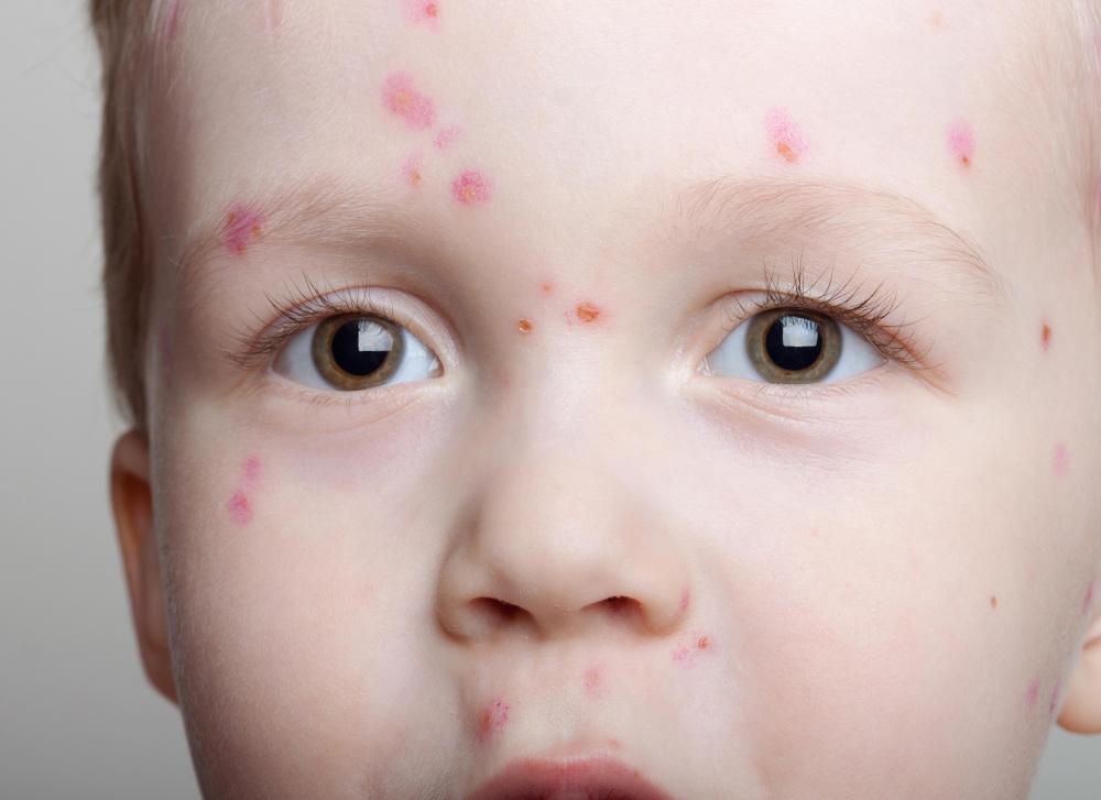 Oregano oil can be relieve itchiness caused by chicken pox.
