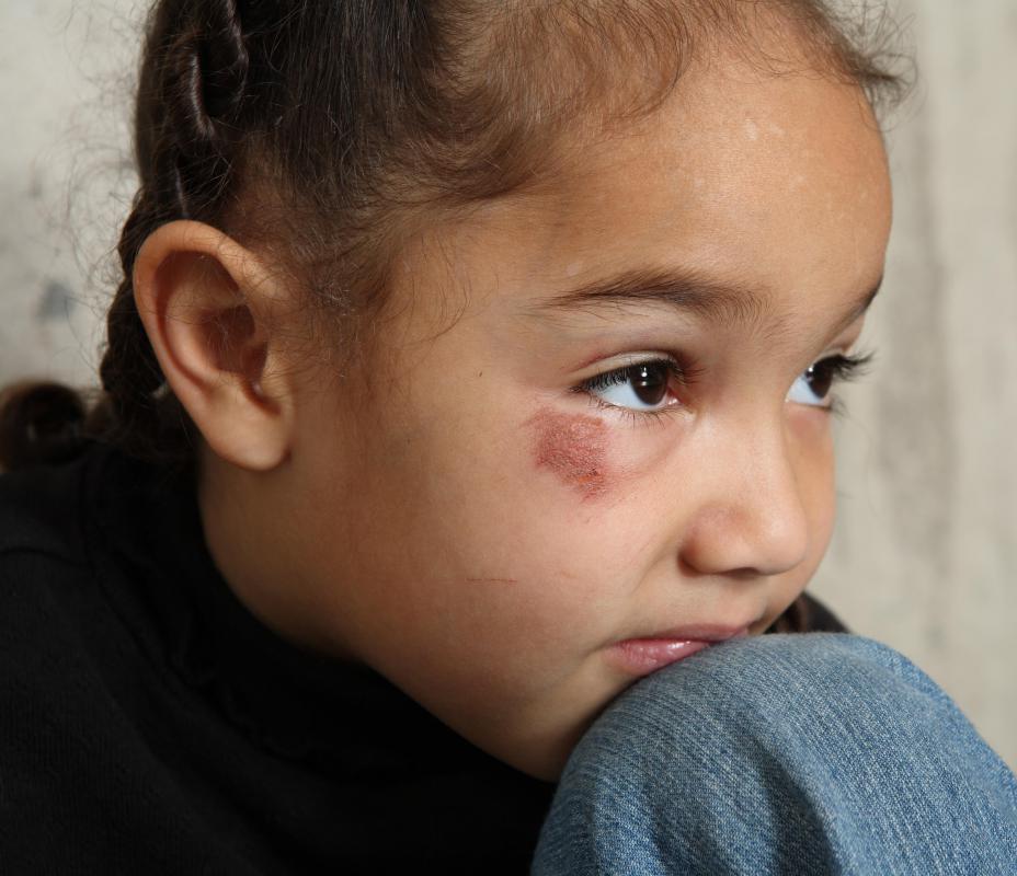 Multiple personality disorder may develop as a result of early childhood abuse.