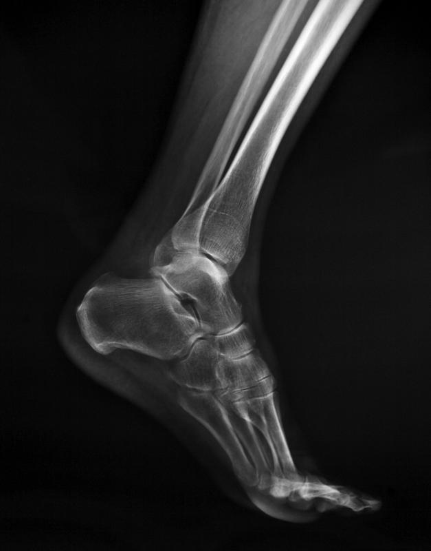 A foot stress fracture is an injury where a small crack appears on the bone.