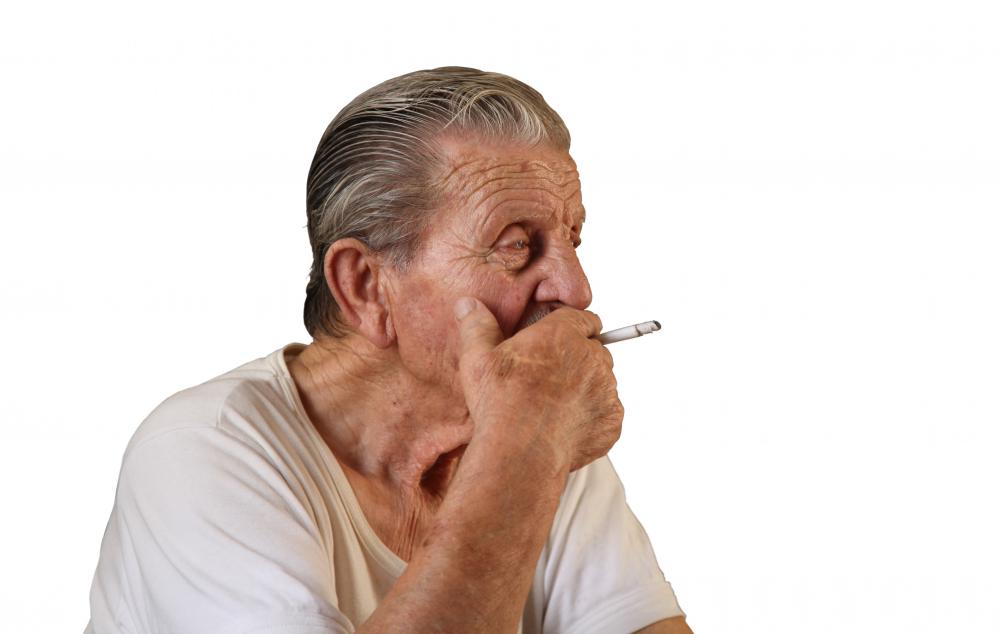 Smokers are at a serious risk of developing squamous cell carcinoma of the tongue.