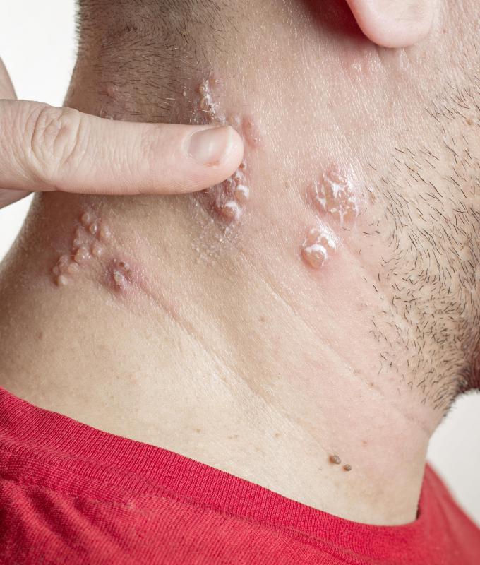 Acyclovir is often used to treat outbreaks of shingles.