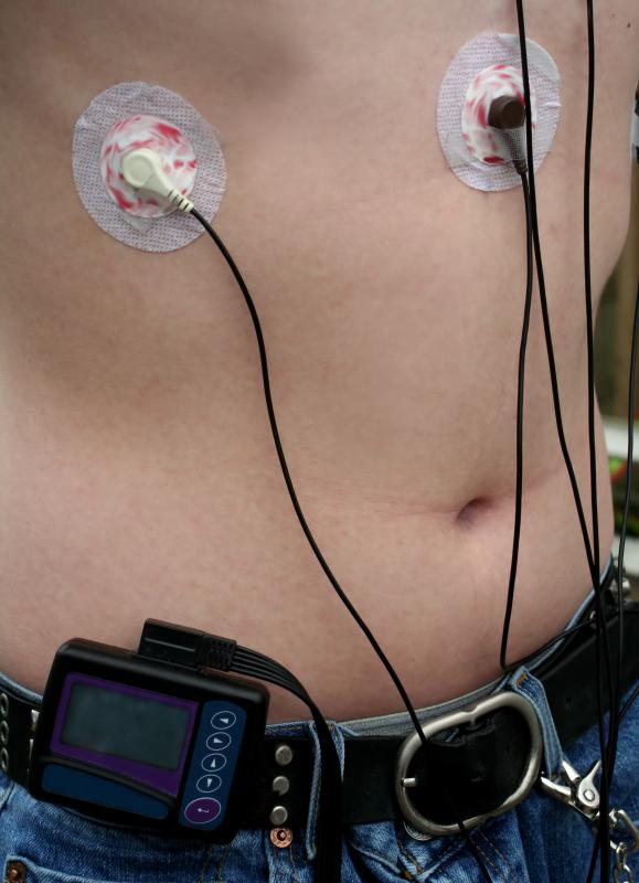 During cardiac monitoring, a patient is fitted with a telemetry transmitter that sends data to the area of the hospital where the monitoring occurs.