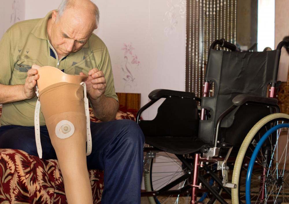 Prosthetic legs allow amputees improved mobility and independence.