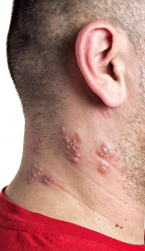 Cantharis may be used to treat shingles.