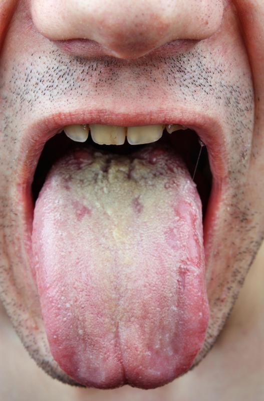 A yeast infection can occur in the mouth.