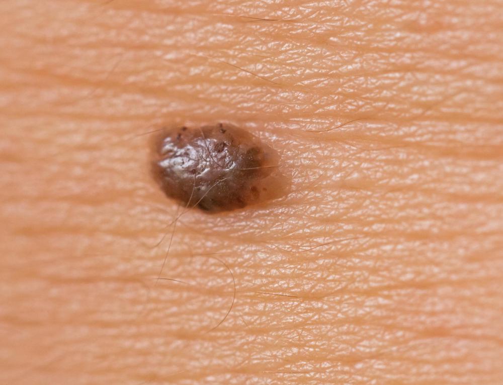 Moles are very similar to freckles, and the two can sometimes be confused with each other.