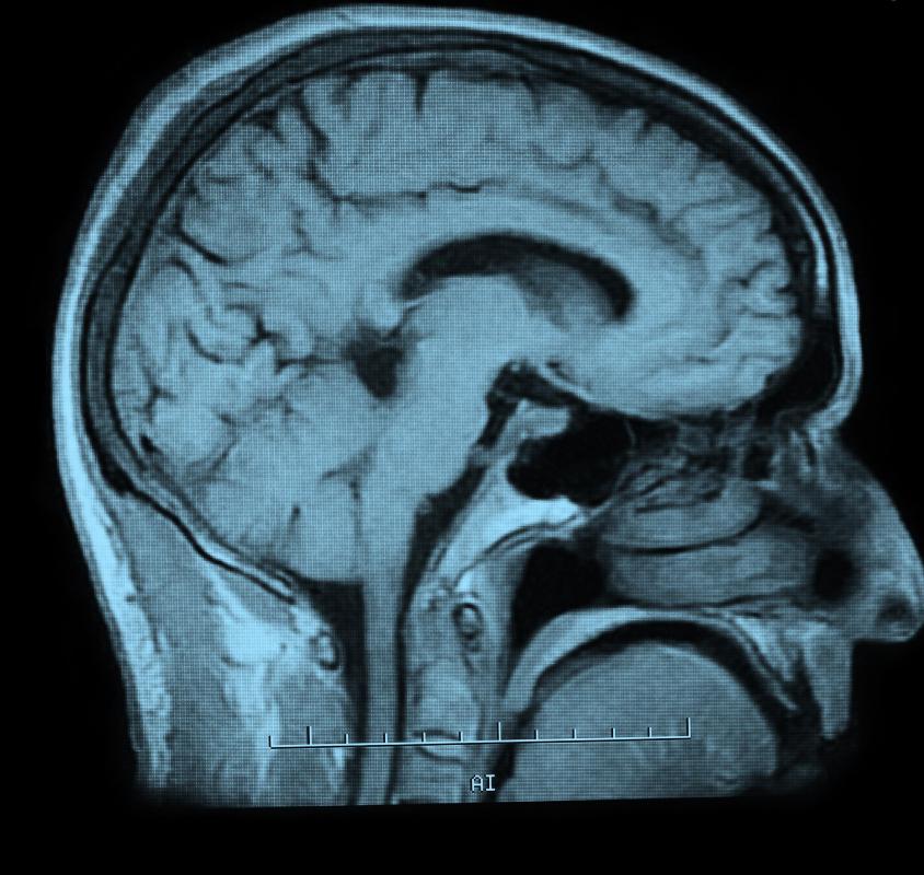 An MRI scan may be conducted to diagnose a brain lesion.
