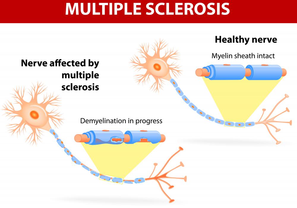 Multiple sclerosis can cause numbness in parts of the body, including the right side.