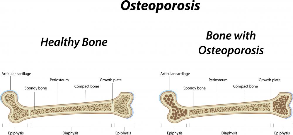 Both strontium and calcium have been proven to be effective in treating osteoporosis.