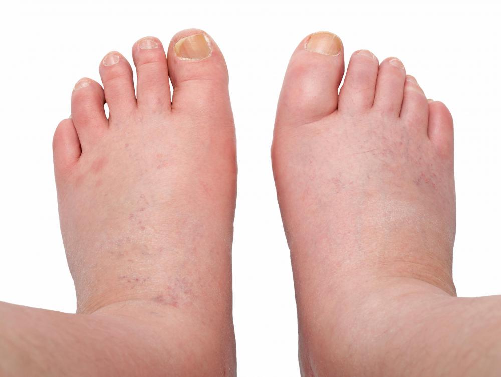 Edema may cause acute inflammation.