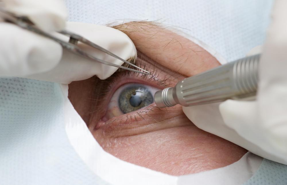 Bleeding of a blood vessel in the iris may occur as a result of an iridotomy.