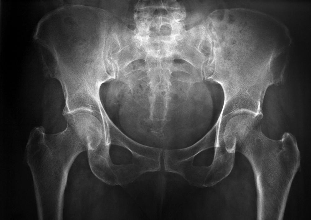 X-rays be used to search for the cause of pain in the sacroiliac joints.
