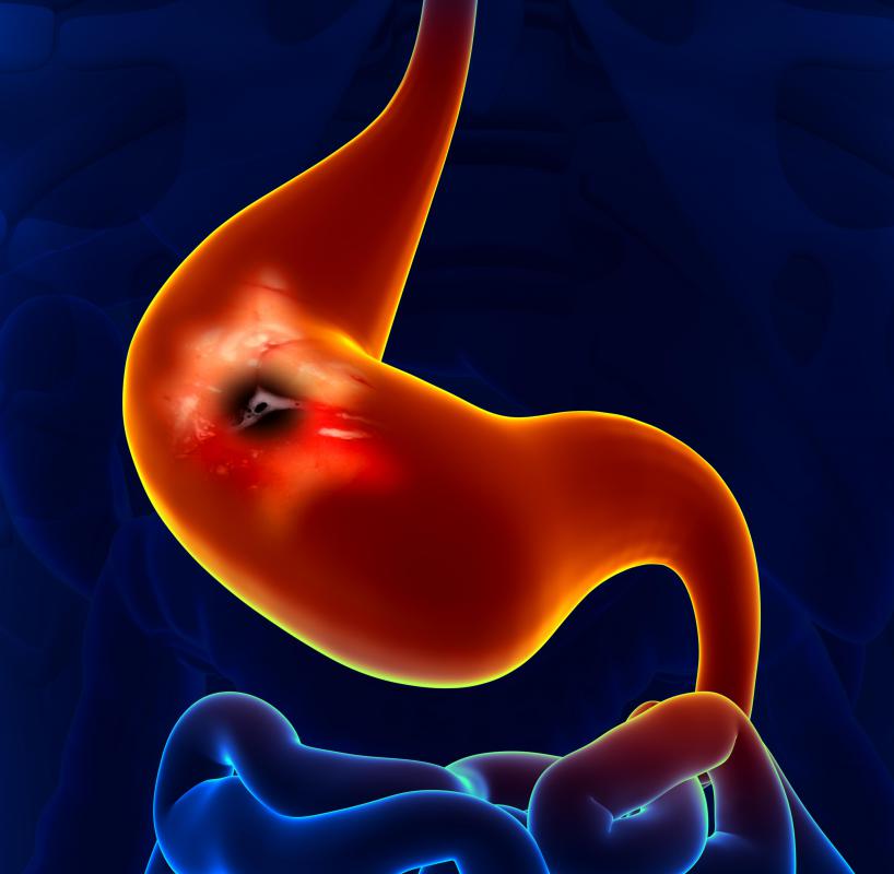 Manuka honey kills the bacteria that causes most stomach ulcers.