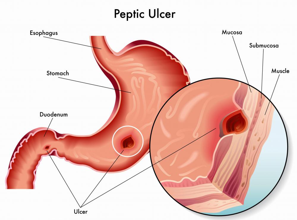 An ulcer is one health condition that can be improved by consuming foods high in S-Methylmethionine.