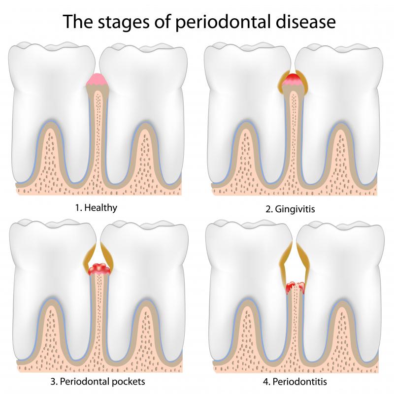 The stages of periodontal disease, which can cause loose teeth.