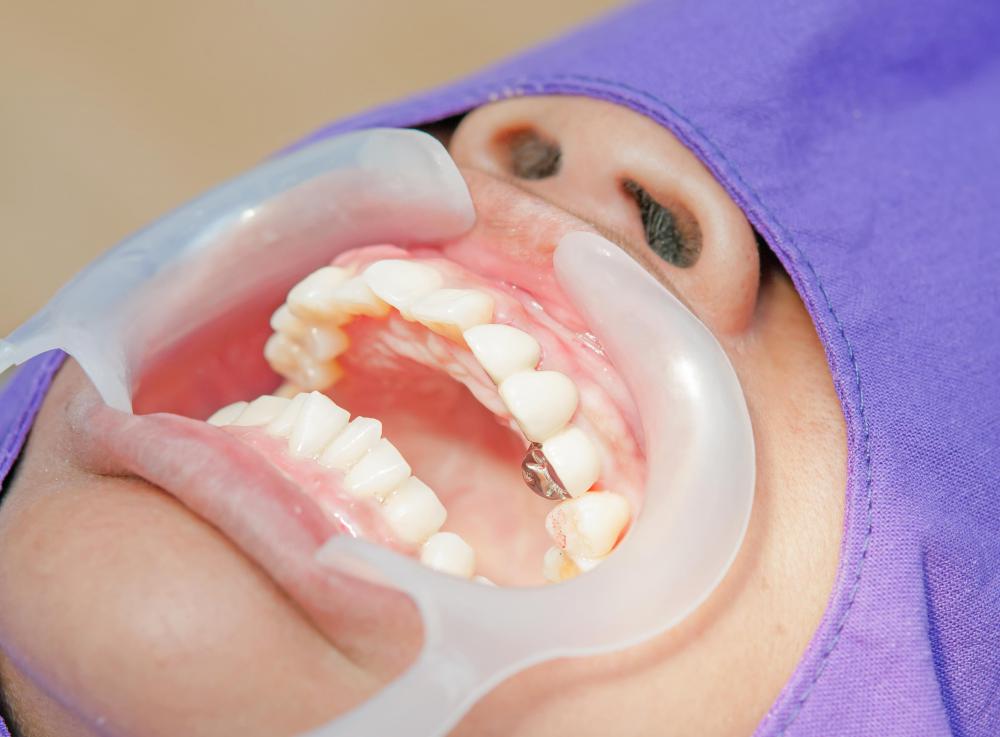 Some versions of the Richardson retractor are designed specifically for use in oral surgery or other dental procedures.