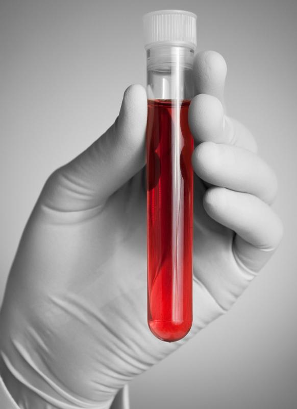 Blood tests can check for some types of connective tissue disease.