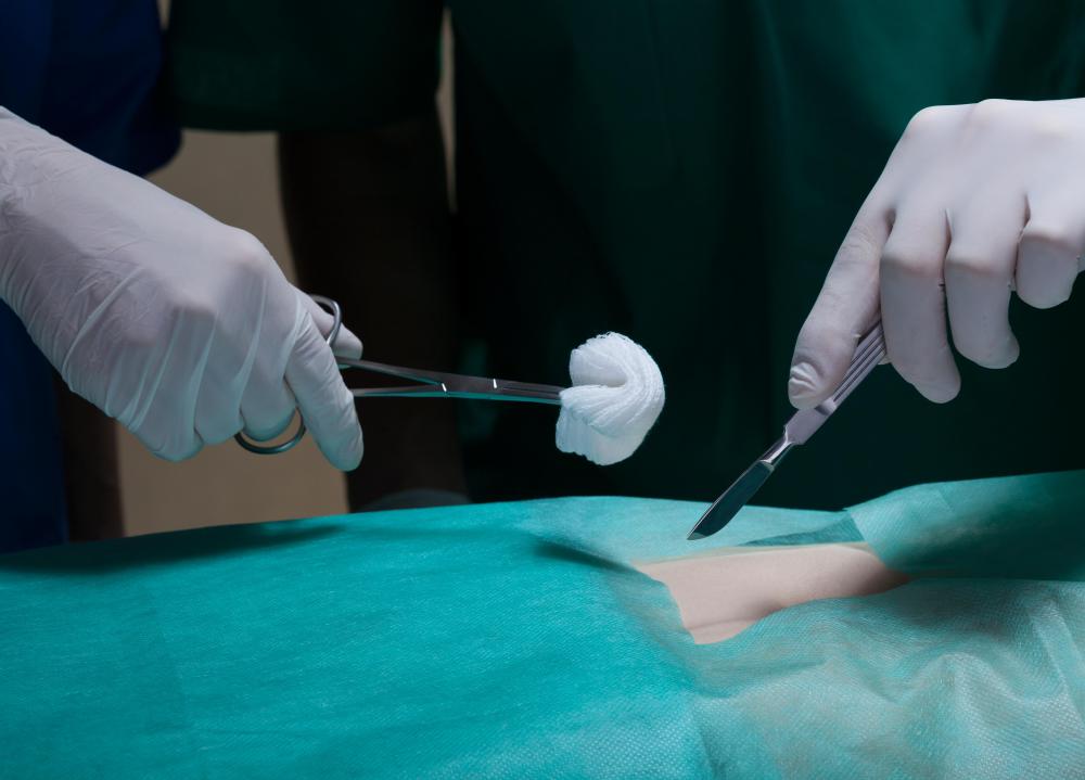 A sump drain may be used for surgical procedures which require drainage for closure of a surgical incision.