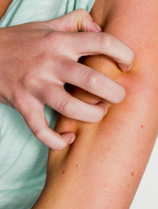 Skin rashes and itching are two symptoms of an allergic reaction to clindamycin.