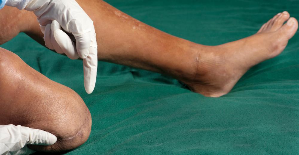 Fractures to the bones of the lower legs could interrupt circulation and eventually lead to circulation.