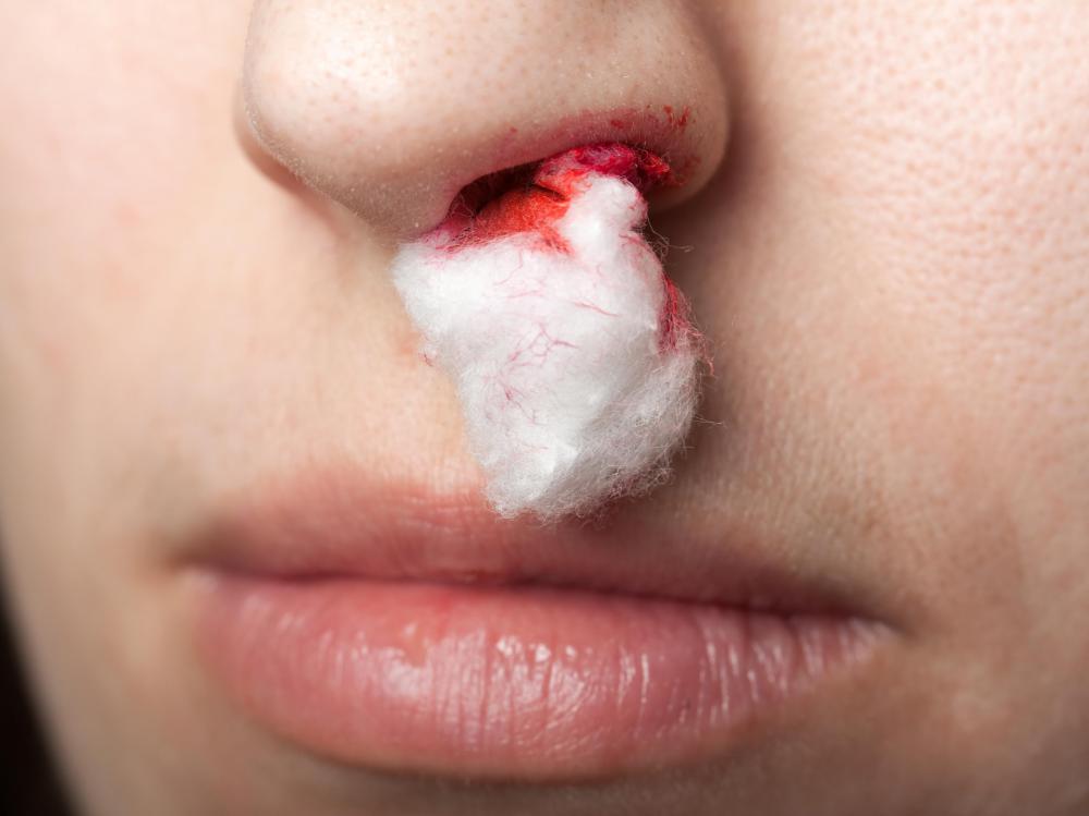 Problems with the blood clotting process may cause nosebleeds.