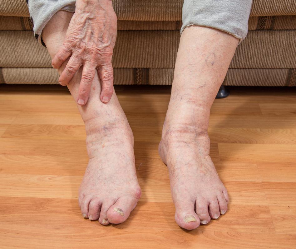 People suffering with turf toe usually experience a change in mobility.