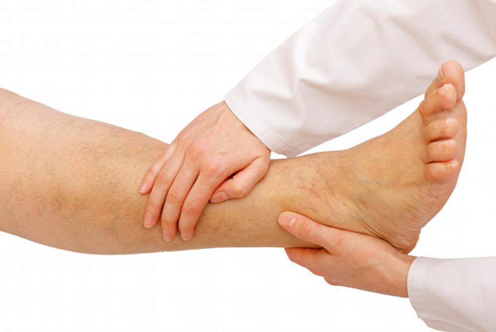 Water pills may be prescribed to treat edema.