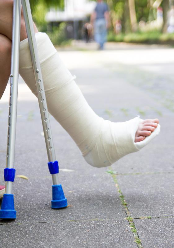Following ankle arthrodesis, patients will need a supportive cast and use crutches.