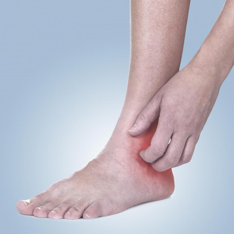 Lichen planus may be the cause of purple skin discoloration that is accompanied by an itchy rash.
