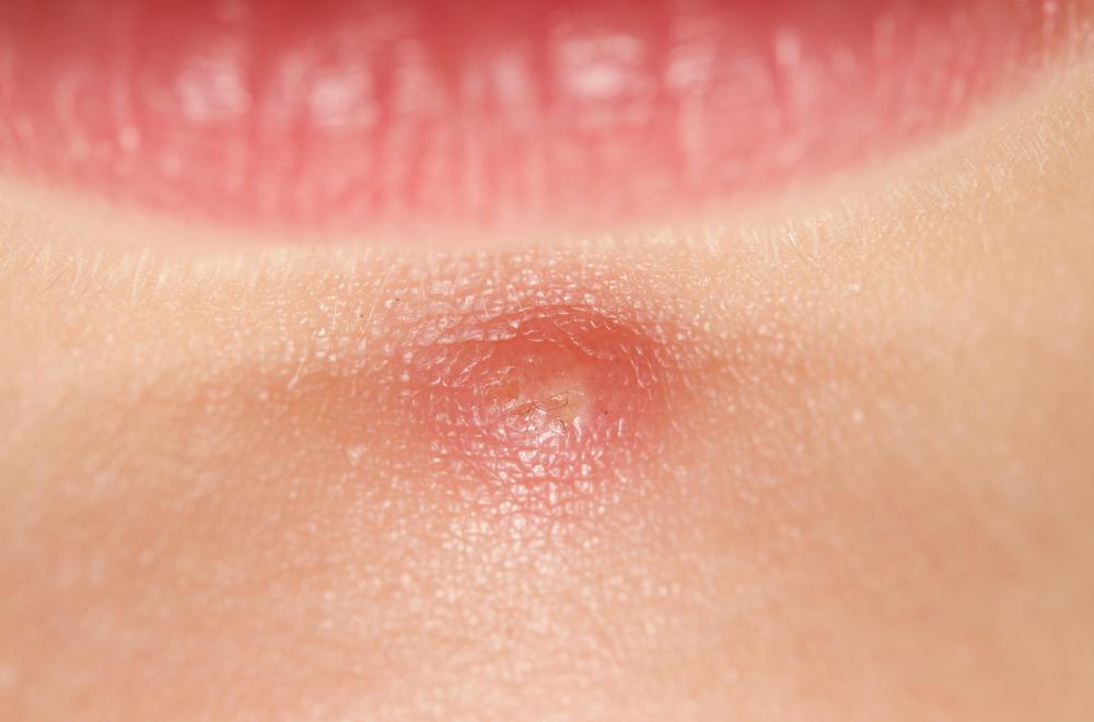 Pimple below lip.