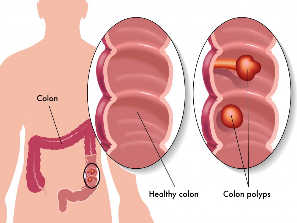 Colon polyps may impede the normal movement of waste through the colon.