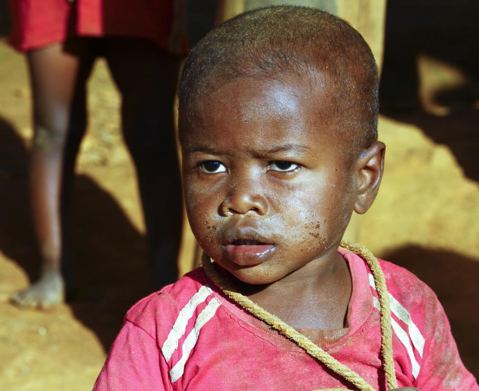 Nearly 25% of every 2,250 children who visit the eye clinics in East Africa have keratoconjunctivitis.