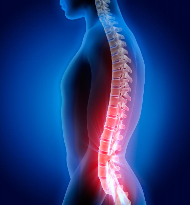 A hemilaminectomy is a surgical procedure performed on the spine that relieves pressure on nerves.